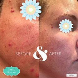 Red Brick Skincare - Acne Treatments (1 month results)