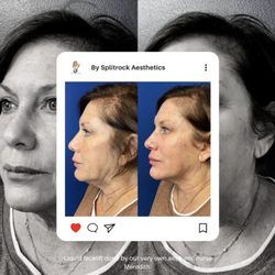 Split Rock Aesthetic Institute - What can properly placed filler do for you? Check THIS out.
#liquidfacelift #fillers #beautifulfaces #ctmedspa #medspact #injector