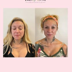 Precision Botox: To complement her new lip symmetry, we used Jeuveau to soften dynamic expression lines.