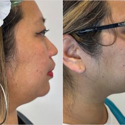 Beautiful Cosmetics MD  - Liquid lipo