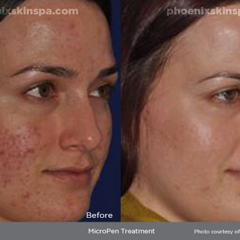 Phoenix Skin Spa - Micro-Needling - Medical Spas Near Me - Phoenix, Arizona