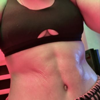 Modern Plastic Surgery - 7 weeks post op tummy tuck - Cosmetic Surgeons Near Me - Calabasas, California Modern Plastic Surgery - 7 weeks post op tummy tuck - Cosmetic Surgeons Near Me - Calabasas, California