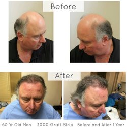 Toronto Hair Transplant Centre - Before and after photos hair transplant - done at our Toronto Hair Transplant Clinic
