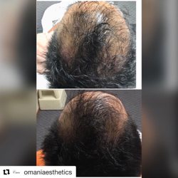 Omani Beauty & Wellness - PRP HAIR RESTORATION before (top) and 3 months after (bottom) 1 treatment