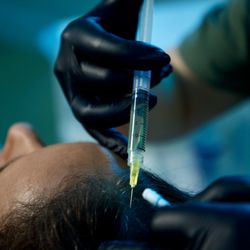 Medicus Aesthetics - Concentrated PRP is injected into the scalp to stimulate follicles and support thicker, healthier hair...