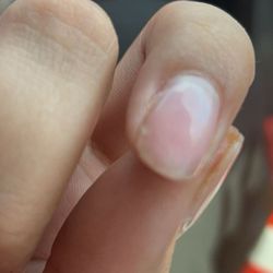 T Nails - Nail broke half way down into the nail bed