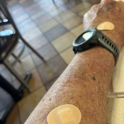 Edward Kramer, MD - Today's ouch. But cancer gone.