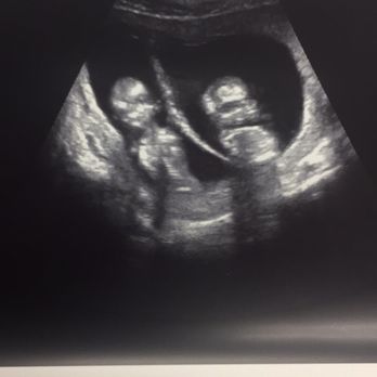 Unique Ultrasound Redlands - My twin babies - Ultrasound Imaging Centers Near Me - Redlands, California