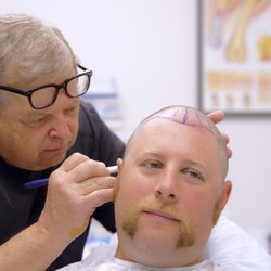 Hair Restoration Institute - Dr Gary Petrus, a double board certified hair transplant surgeon plans out a FUE Hair transplant for a client in Bloomington Minnesota.