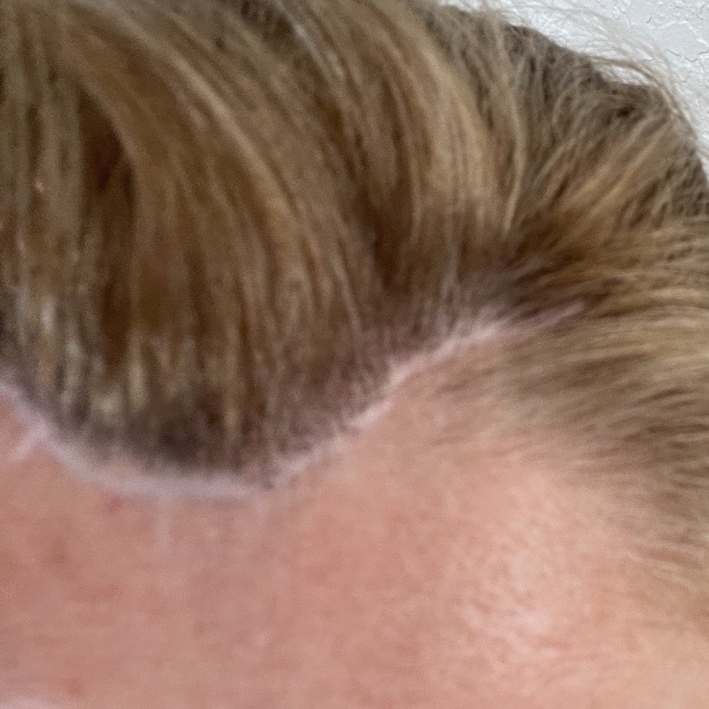 CosMed - Brown lift scar - Cosmetic Surgeons Near Me - Tijuana, BCN