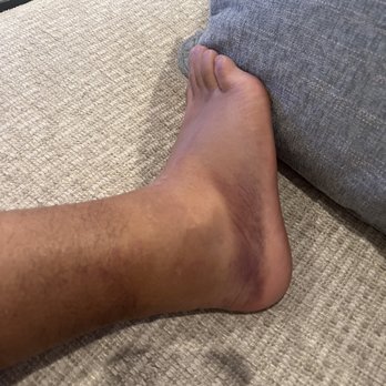 Flow State Cryo & Recovery - Sprained ankle - Cryotherapy Near Me - Studio City, California Flow State Cryo & Recovery - Sprained ankle - Cryotherapy Near Me - Studio City, California