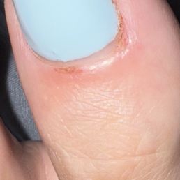 What my toes looked like after cutting it 3 times making it bleed. What my toes looked like after cutting it 3 times making it bleed.