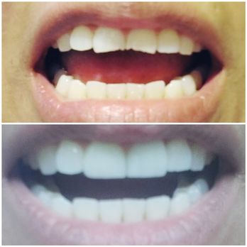 Dreamscape Dental Arts - Porcelain veneers - General Dentistry Near Me - San Marcos, California