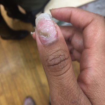 Barry's Beauty Bar Queens - Fungus on my nail from this salon! - Day Spas Near Me - Rosedale, New York