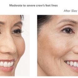 Singer Cosmetics - Before (left photo) Botox around the eyes. After (right photo) Botox around the eye.