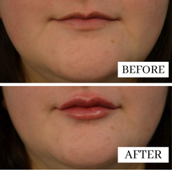 The Gillian Institute - Amber used one syringe of Restylane Defyne, giving this patient a natural pout.