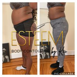 Esteem Body Contour by Kei - Non invasive Lipo cavitation