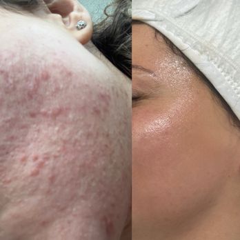 Scins Skins’ Aesthetic Clinic - Before & After second treatment! - Aestheticians Near Me - Glendale, California Scins Skins’ Aesthetic Clinic - Before & After second treatment! - Aestheticians Near Me - Glendale, California