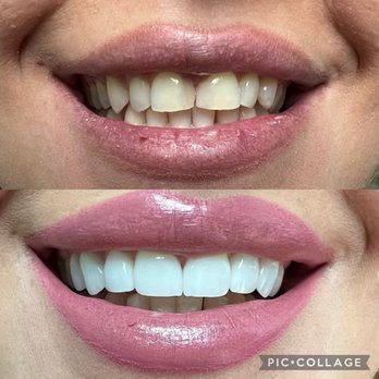 Atrium Dental -Harry H. Elyassi DMD - Teeth Whitening Near Me - Glendale, California