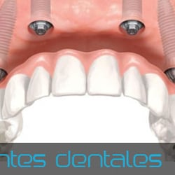 Aviles y Roman - Clinica dental malaga - Implantes Dentales