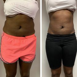 Ynobe Beauty Lounge - Progress photos of laser Lipo + Lipo Cavitation