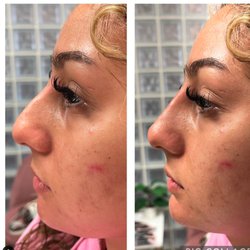 Skintastic Medi Spa - Non surgical nose job with filler