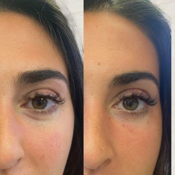 Allure Aesthetics - Tear Trough Filler - Medical Spas Near Me - Boca Raton, Florida