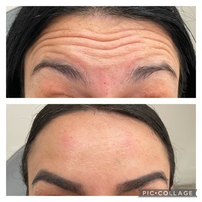 Botox and Filler - Our highly trained and licensed injectors focus on subtle enhancements that balance your features and refresh your look—without sacrificing your unique beauty. Experience confidence that comes from looking like the very best version of yourself. Schedule your personalized consultation today for results that are naturally you. Botox and Filler - Our highly trained and licensed injectors focus on subtle enhancements that balance your features and refresh your look—without sacrificing your unique beauty. Experience confidence that comes from looking like the very best version of yourself. Schedule your personalized consultation today for results that are naturally you.