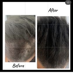 Dee's Laser & Medspa - PRP hair restoration