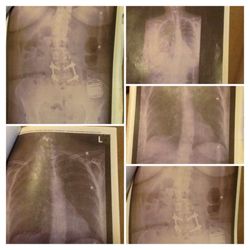 Hongyan Zou, MD PhD - What the Spinal cord stimulator had caused my spine traumatic scoliosis. Inserted to far to the right wires were tethered .