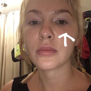 MiracleFace MedSpa - Undereye - Medical Spas Near Me - New York, New York