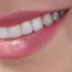 My Smile Miami - AFTER!