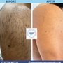 Simply Laser Hair Removal and Skin Clinic