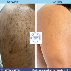 Simply Laser Hair Removal and Skin Clinic - Men's shoulders and upper arms laser hair removal results showing a clear reduction in dense hair and smoother skin after treatment.