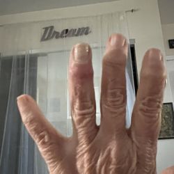 Providence Performance Therapy - Ring finger fusion looking so much better!