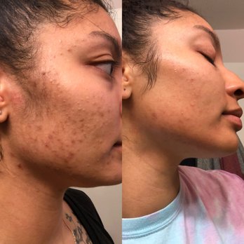 Confident Complexion Skin Care - Before and After 6 months(right) - Acne Treatment Near Me - San Diego, California