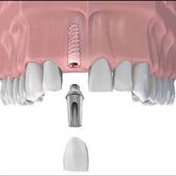 Eric K. Taylor, DDS - Dental Titanium Implant