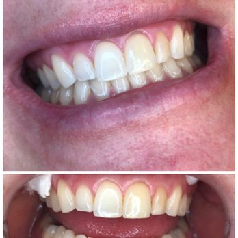 Bungalow Sugar - Teeth whitening - Teeth Whitening Near Me - Huntington Beach, California Bungalow Sugar - Teeth whitening - Teeth Whitening Near Me - Huntington Beach, California
