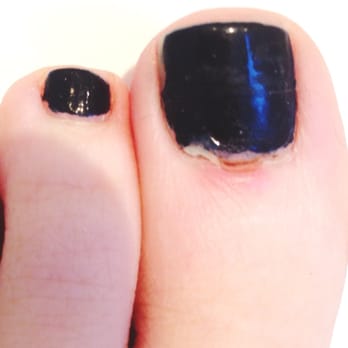 Great Nails & Spa - five days later. what is that nasty white thing? my cuticle holding on for dear life. gross. useless, painful pedicure. - Nail Salons Near Me - Austin, Texas Great Nails & Spa - five days later. what is that nasty white thing? my cuticle holding on for dear life. gross. useless, painful pedicure. - Nail Salons Near Me - Austin, Texas
