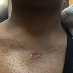 Illinois Dermatology Institute - A horrible scar