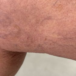 Apex Vein and Vascular Institute - Spider veins inside my right knee.