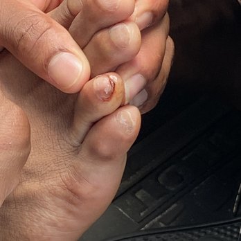 Larry Nail Impressions - Bruised toe - Nail Salons Near Me - Hallandale beach, Florida Larry Nail Impressions - Bruised toe - Nail Salons Near Me - Hallandale beach, Florida