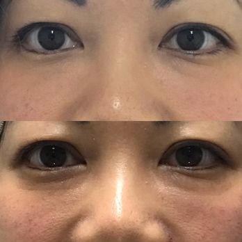 My Aesthetics Intelligence - Top is immediately after. Bottom is before. Annie used filler under my eyes. - Medical Spas Near Me - Dallas, Texas