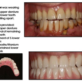 Dental Implants Miami Beach - implant restoration- full mouth - Cosmetic Dentists Near Me - Miami Beach, Florida Dental Implants Miami Beach - implant restoration- full mouth - Cosmetic Dentists Near Me - Miami Beach, Florida