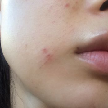 Alira MedSpa - cuts and abrasions on my other cheek. - Day Spas Near Me - Houston, Texas Alira MedSpa - cuts and abrasions on my other cheek. - Day Spas Near Me - Houston, Texas