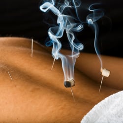 Daniel Haun, LAc - Warming needle therapy