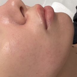 RF Facial RF Facial