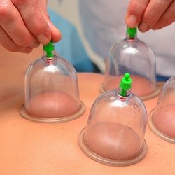 Siesta Massage - Add on cupping to your massage session !
