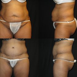Harold E. Beam, MD - Tummy Tuck (Abdominoplasty)