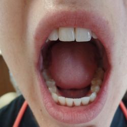 Platinum Smiles Family Dentistry - After Invisalign